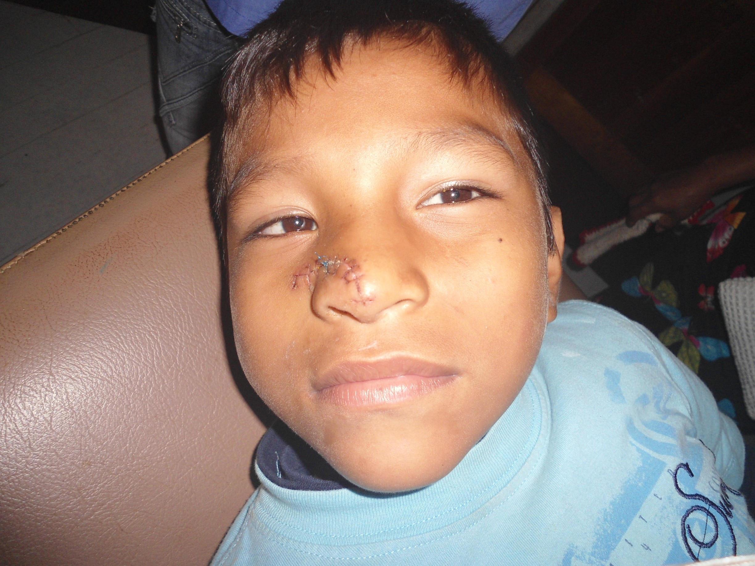 Lacnose Lacnose